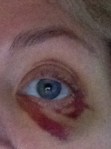 black eye